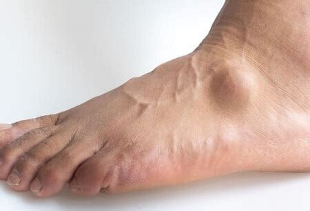 What Causes a Lump on Upper Foot and How to Treat It Effectively