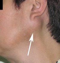 What Causes a Lump Under Jaw and How to Treat It