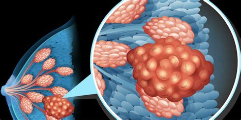 Understanding Lumps in Breast: What You Need to Know About Causes, Symptoms, and Treatment Options