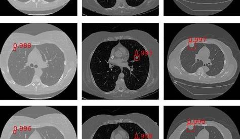 Luna16 Dataset Download Statistics Of The In The Lung Nodule Analysis 2016