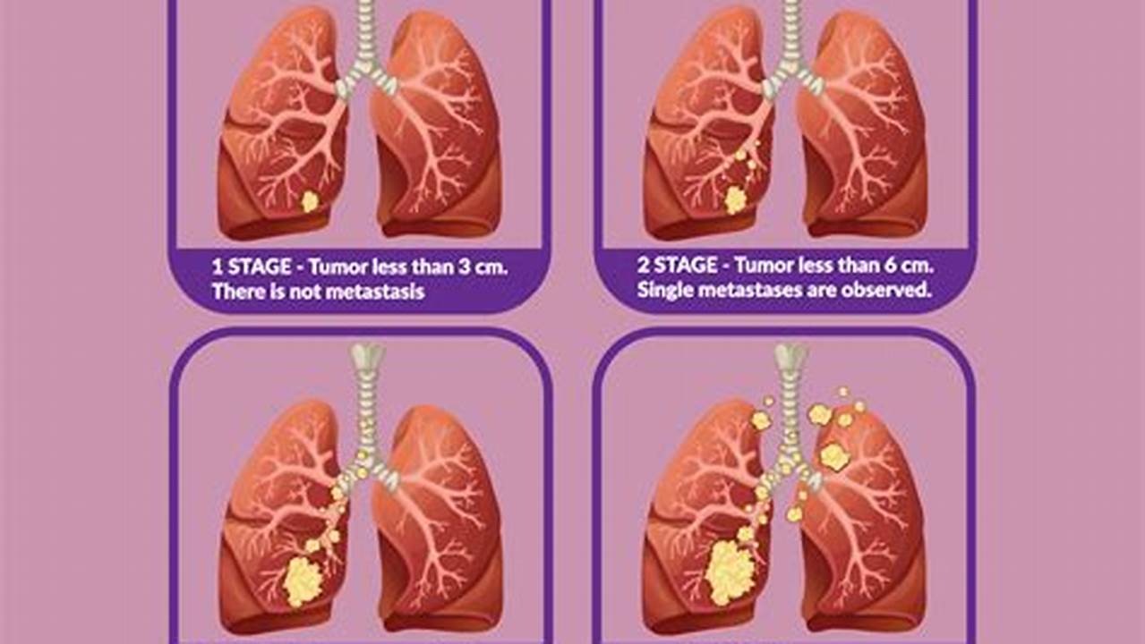 Lung Cancer Stages: A Comprehensive Guide for Informed Decisions
