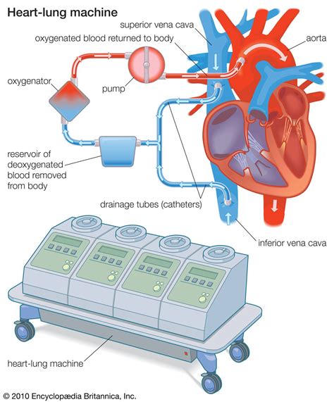 Revolutionizing Medical Care: The Life-Changing Lung and Heart Machine Explained
