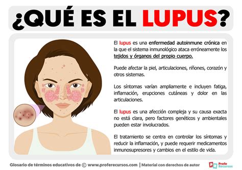 Lupus Que Es: Understanding the Mysterious Chronic Disease