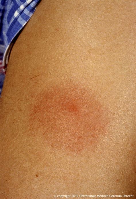 lyme disease bullseye rash images