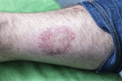 lyme disease rash photos bullseye