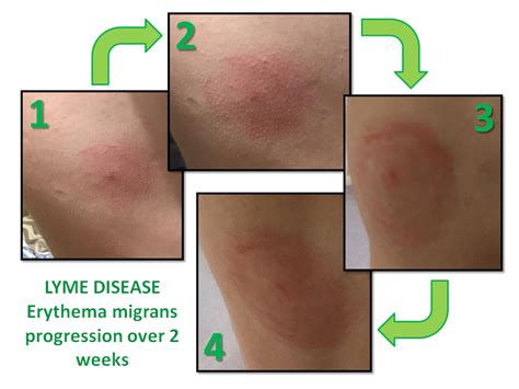 Lymes Disease Progression