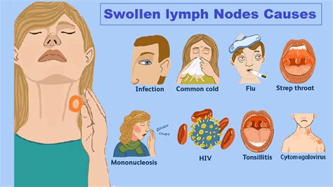 What Causes Lymph Glands Swollen: Symptoms and Treatment Options
