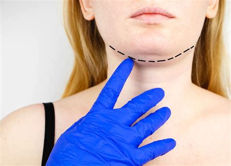 Lymph Node Swelling Under Chin: Causes and Treatment Options