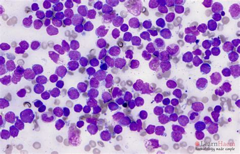 lymphoblastic leukaemia