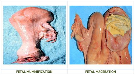 Maceration Fetus