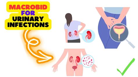 Macrobid Side Effects: What You Need to Know Today