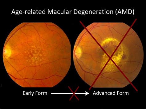 Macular Degeneration Zero To Finals