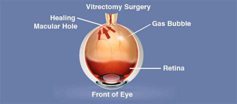 macular hole eye surgery