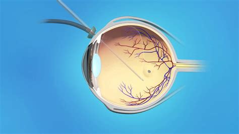 macular hole in retina surgery