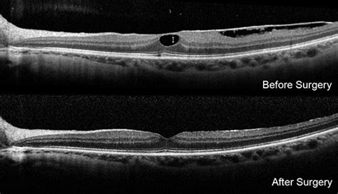 Understanding Macular Pucker Surgery: Risks, Benefits, and Recovery Insights