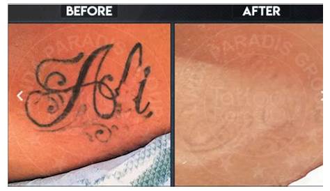 Magnetic Tattoo Removal Aftercare Before After 7 PMU By Linda Paradis YouTube