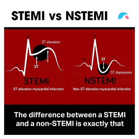 main difference between nstemi and stemi