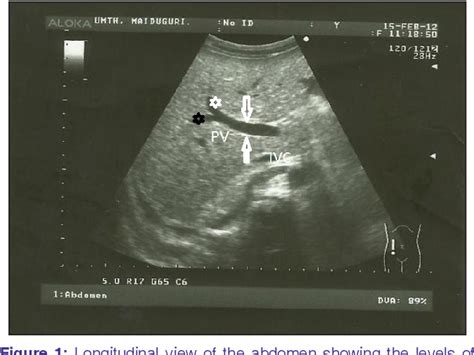 main portal vein diameter