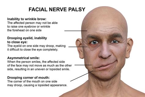 main symptoms of bells palsy