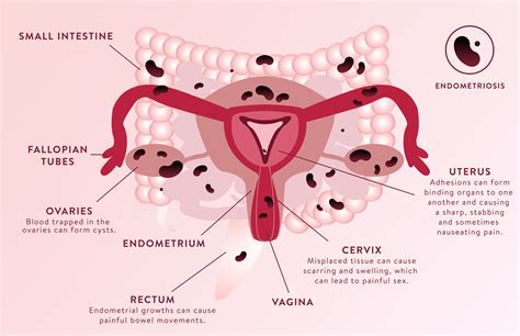main symptoms of endometriosis