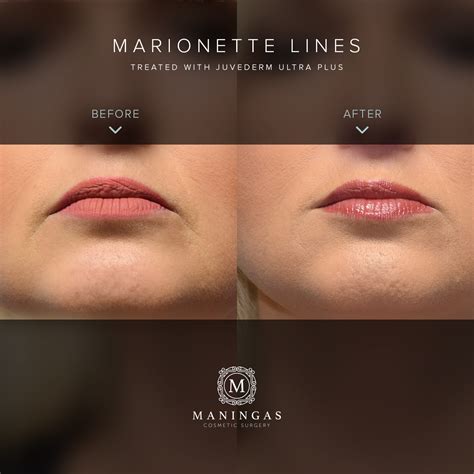 Maintaining Results for Marionette Lines