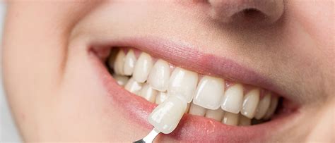 Maintenance On Veneers