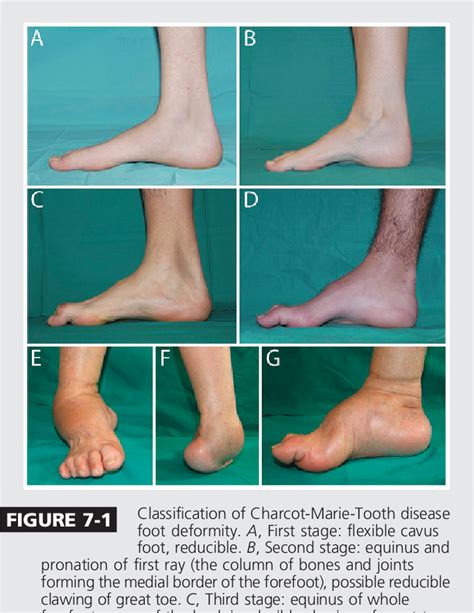 maladie de charcot marie tooth type 1a