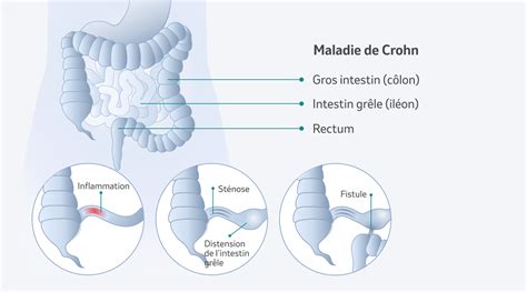 maladie de crohn est ce grave