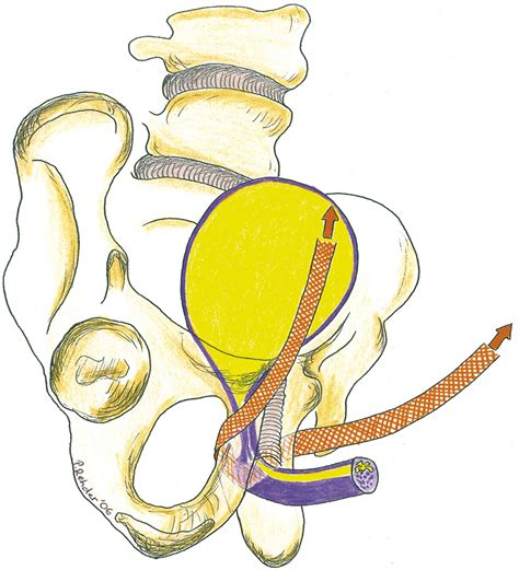 male bladder sling procedure