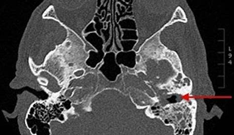 Malignant Otitis Externa Radiology Neuroradiology On The Net