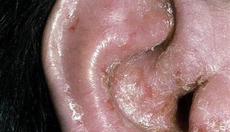 Acute Otitis Externa An Update American Family Physician