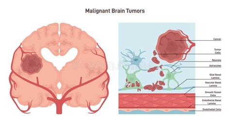 malignant brain tumours