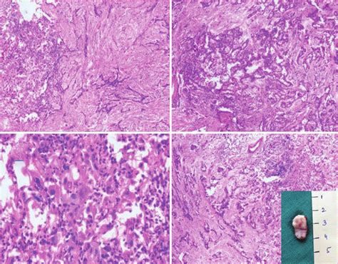 Malignant Epithelioid