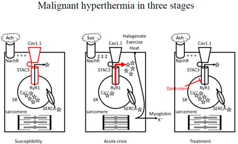 Malignant Hyperthermia Joint Commission