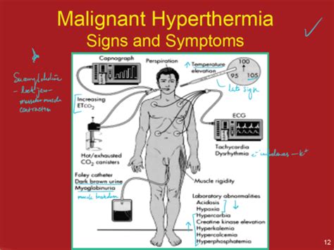 Malignant Hyperthermia Quizlet