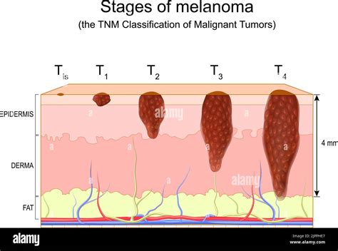 malignant melanoma cannot metastasize