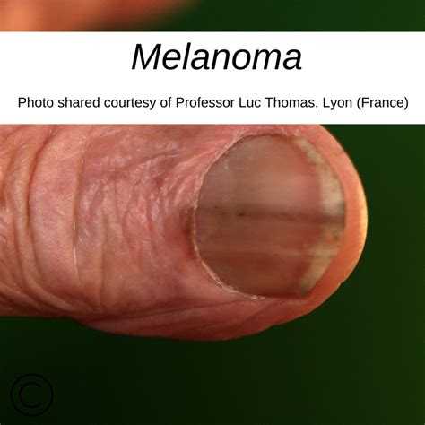 malignant melanoma nail bed