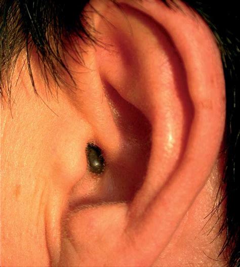 malignant melanoma on ear