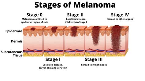 malignant melanoma prognosis by stage