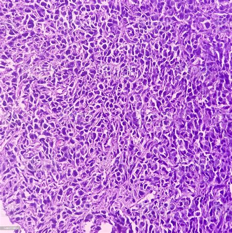 Malignant Neoplasm Sarcoma