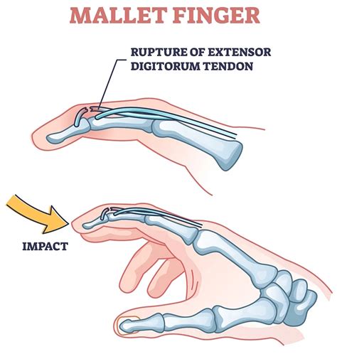 Mallet Finger Meaning