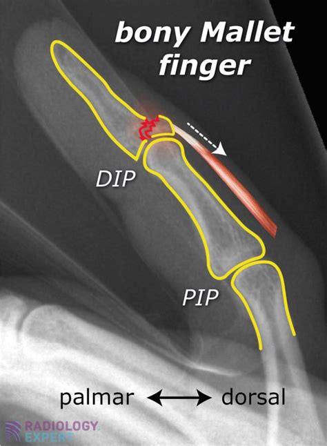 Mallet Finger Permanent Deformity
