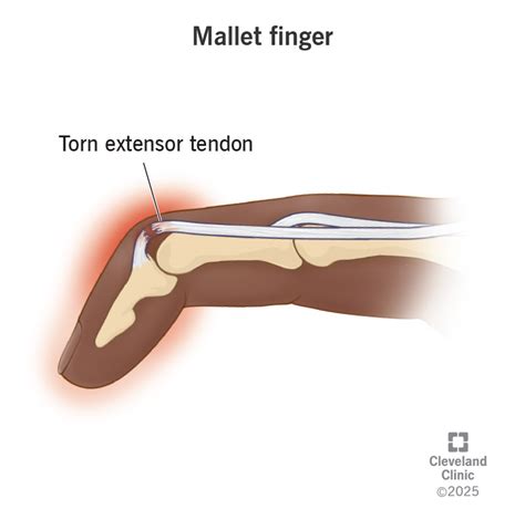 Mallet Finger Physiopedia