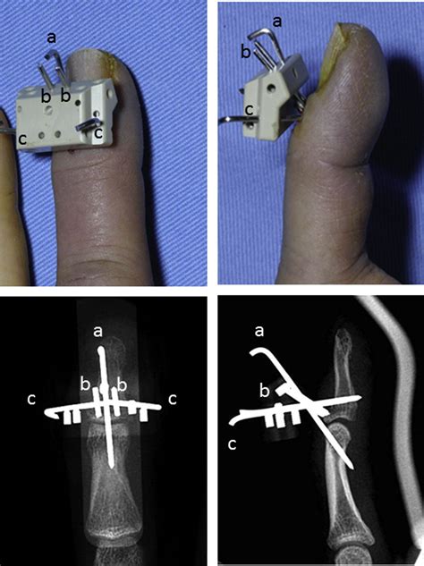 Mallet Finger Pin Surgery