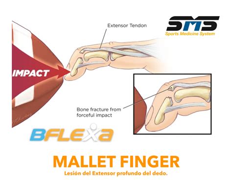 Mallet Finger Que Es
