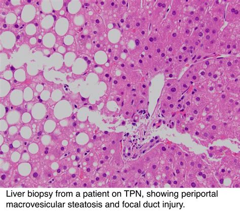 Pathology Outlines Extrahepatic biliary atresia