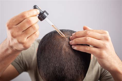 Man applying minoxidil