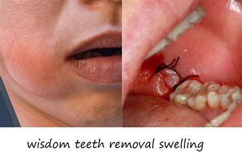 managing swelling after tooth extraction