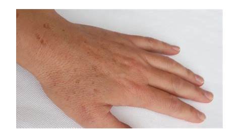 Cómo quitar las manchas de las manos con láser | IML