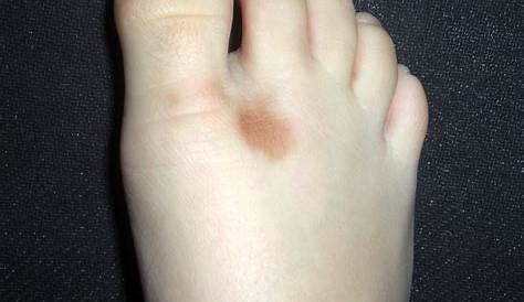 Lunar en el pie que ha cambiado de color – dermatologo.net